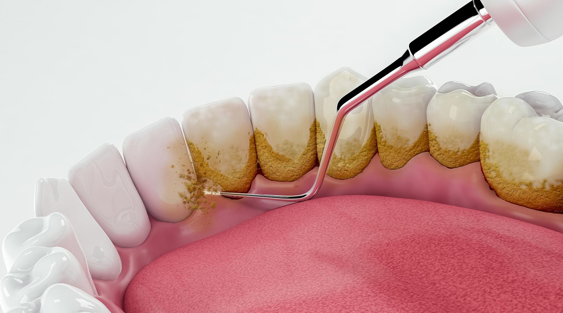ascent-dental-care-blog-header-38
