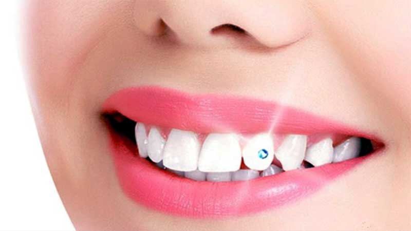 dental-jewelry