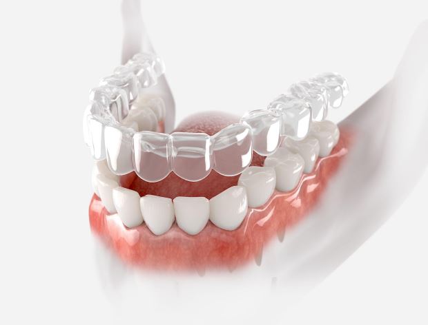 clear-aligners-model