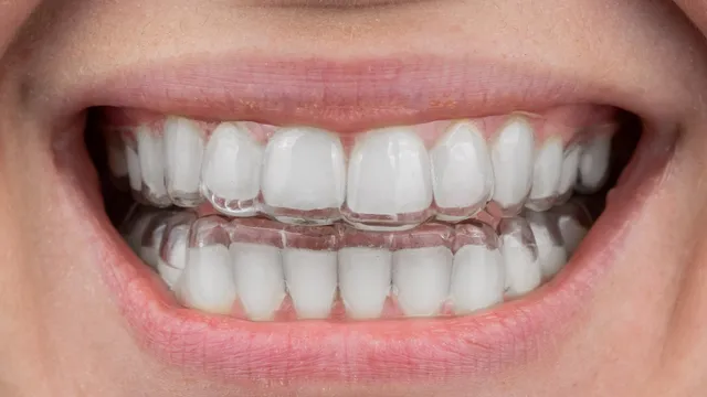 clear+aligners+over+nice+teeth+in+patients+mouth-640w