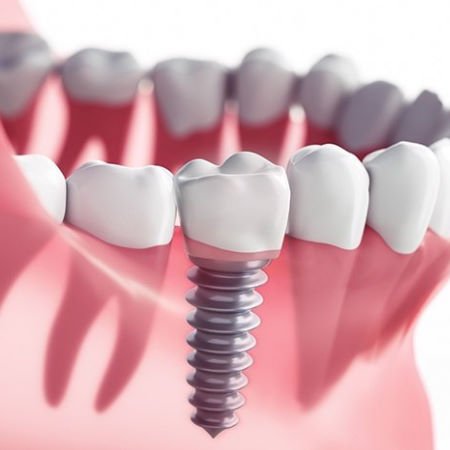 dental-implant-2