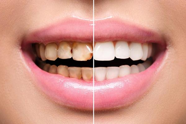 laminates-veneers